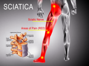 Final Stages of Sciatica